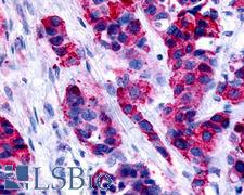 GPER1 / GPR30 Antibody - Anti-GPR30 antibody IHC staining of human breast carcinoma. Immunohistochemistry of formalin-fixed, paraffin-embedded tissue after heat-induced antigen retrieval.