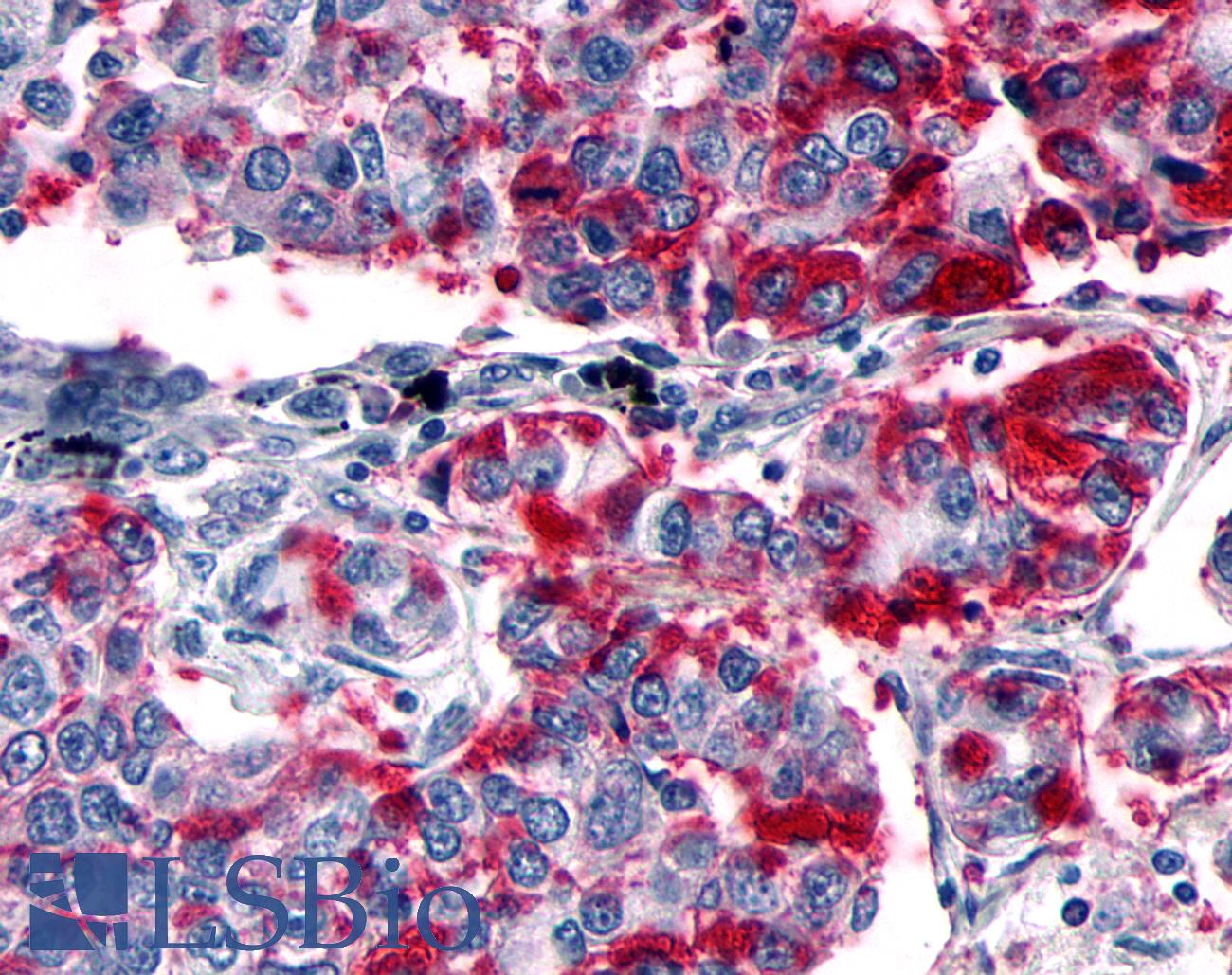 GPER1 / GPR30 Antibody - Anti-GPER1 / GPR30 antibody IHC of human Lung, Non-Small Cell Carcinoma. Immunohistochemistry of formalin-fixed, paraffin-embedded tissue after heat-induced antigen retrieval.