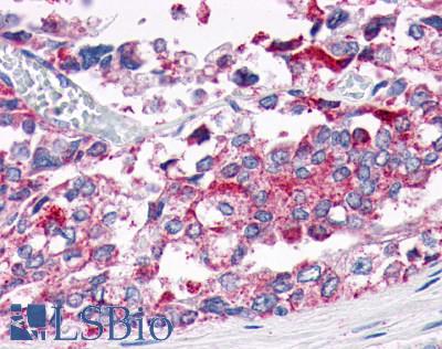 GPER1 / GPR30 Antibody - Prostate, adenocarcinoma