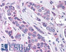 GPER1 / GPR30 Antibody - Anti-GPR30 antibody IHC of human breast carcinoma. Immunohistochemistry of formalin-fixed, paraffin-embedded tissue after heat-induced antigen retrieval.