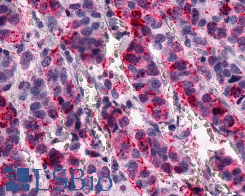 GPR1 Antibody - Anti-GPR1 antibody IHC of human Breast, Carcinoma. Immunohistochemistry of formalin-fixed, paraffin-embedded tissue after heat-induced antigen retrieval.