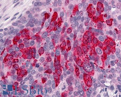 GPR1 Antibody - Ovary, Carcinoma