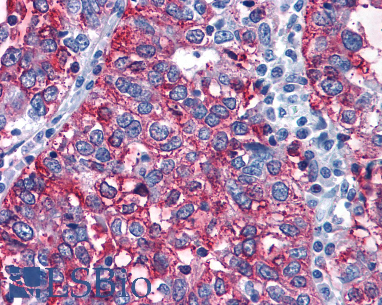 GPR108 Antibody - Anti-GPR108 antibody IHC of human Ovary, Carcinoma. Immunohistochemistry of formalin-fixed, paraffin-embedded tissue after heat-induced antigen retrieval.