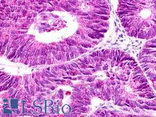 GPR12 Antibody - Ovary, Carcinoma