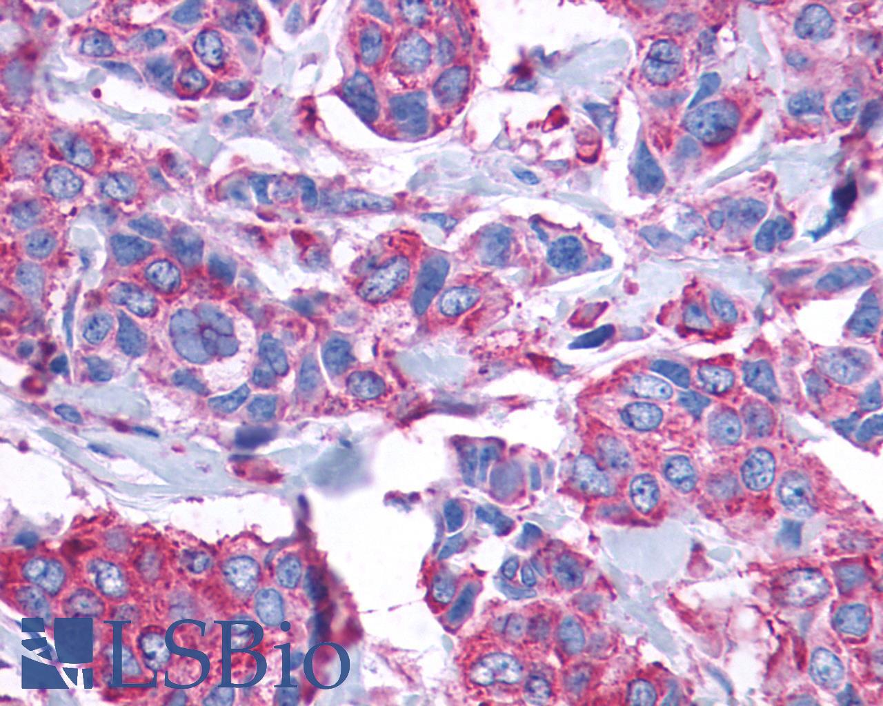 GPR132 / G2A Antibody - Breast, Carcinoma