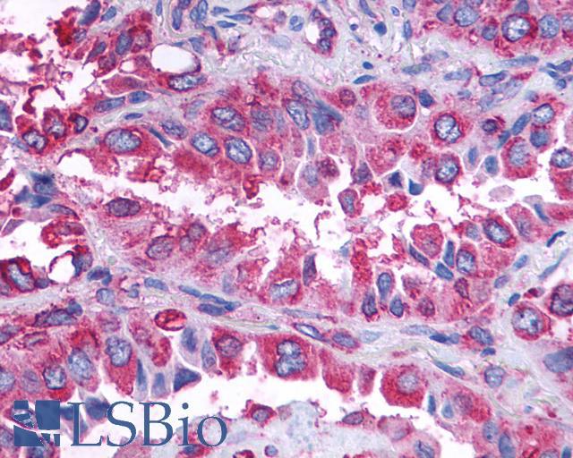 GPR132 / G2A Antibody - Lung, Non Small-Cell Carcinoma
