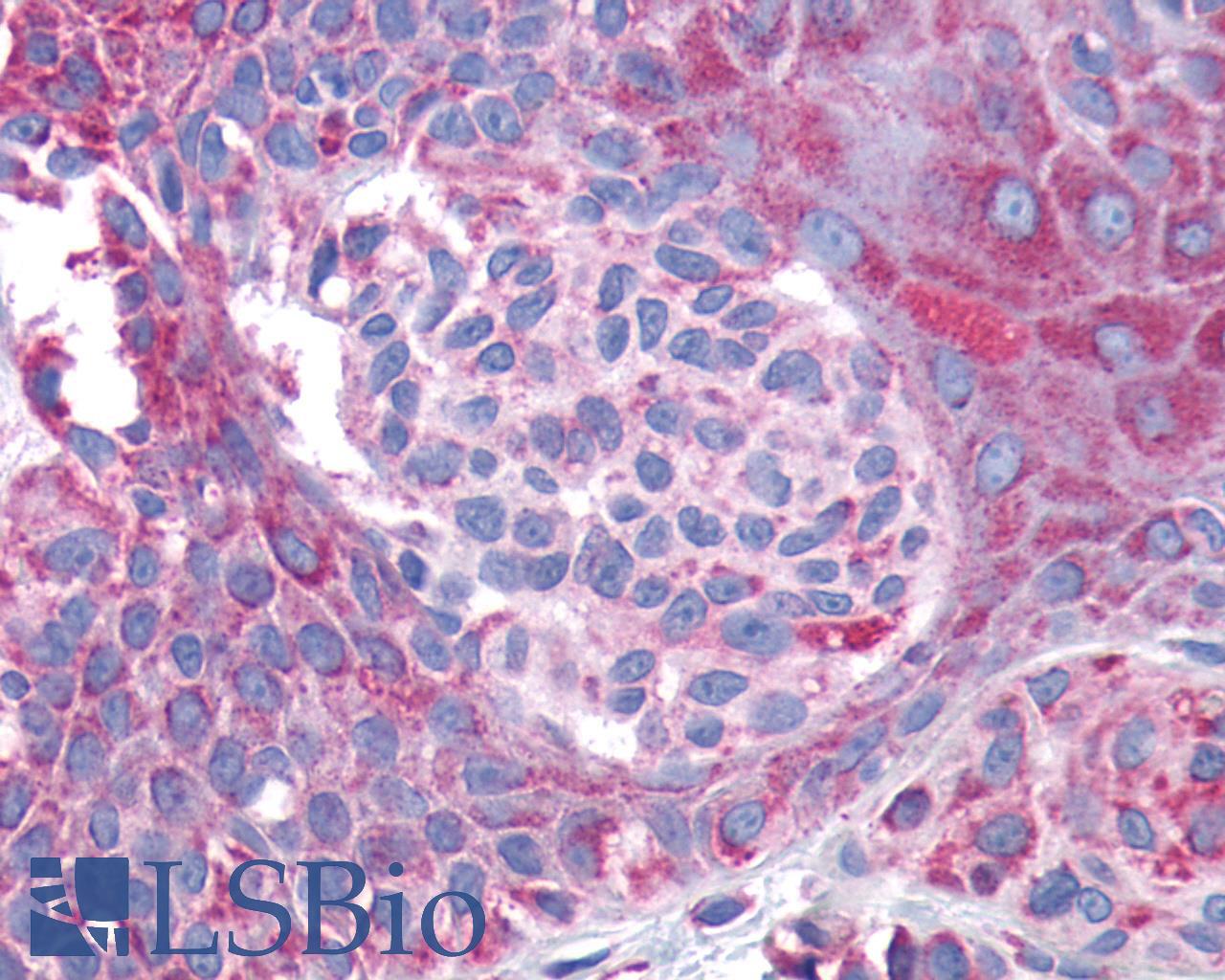 GPR132 / G2A Antibody - Skin, Malignant Melanoma
