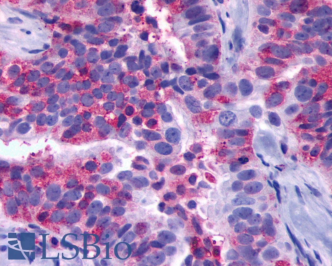GPR137B Antibody - Anti-GPR137B antibody IHC of human Ovary, Carcinoma. Immunohistochemistry of formalin-fixed, paraffin-embedded tissue after heat-induced antigen retrieval.