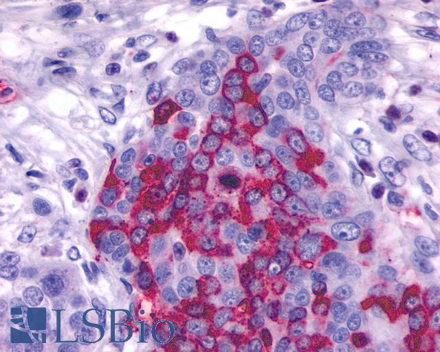 GPR137B Antibody - Anti-GPR137B antibody IHC of human Ovary, Carcinoma. Immunohistochemistry of formalin-fixed, paraffin-embedded tissue after heat-induced antigen retrieval.