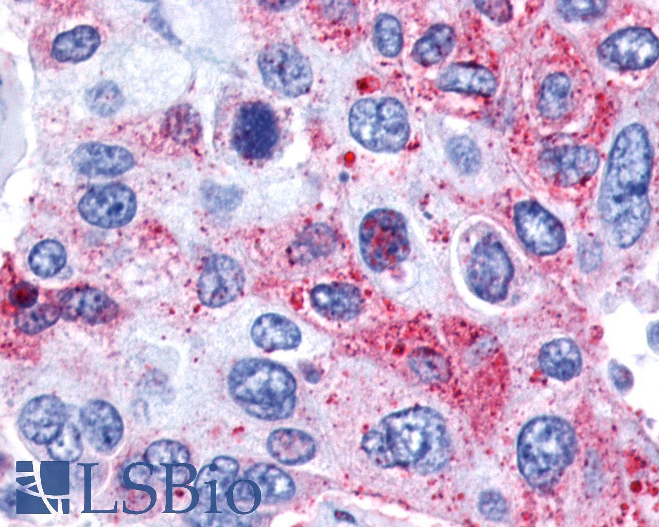 GPR139 Antibody - Lung, Adenocarcinoma