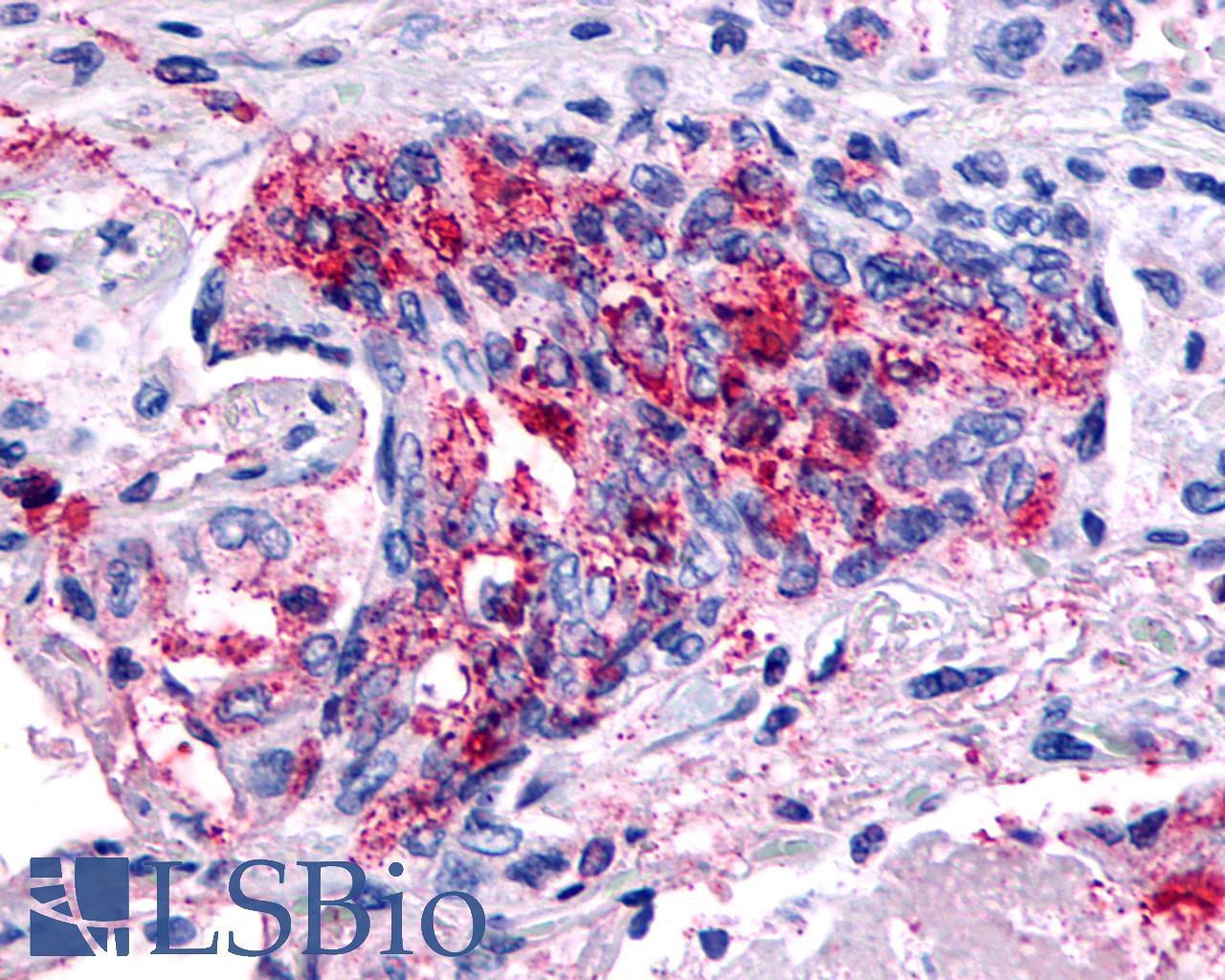 GPR139 Antibody - Lung, Adenocarcinoma