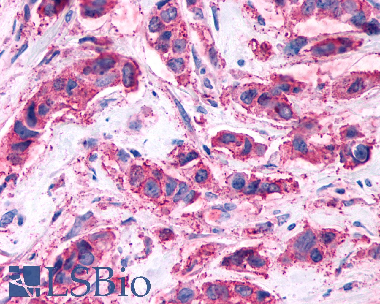 GPR146 Antibody - Anti-GPR146 antibody IHC of human Breast, Carcinoma. Immunohistochemistry of formalin-fixed, paraffin-embedded tissue after heat-induced antigen retrieval.