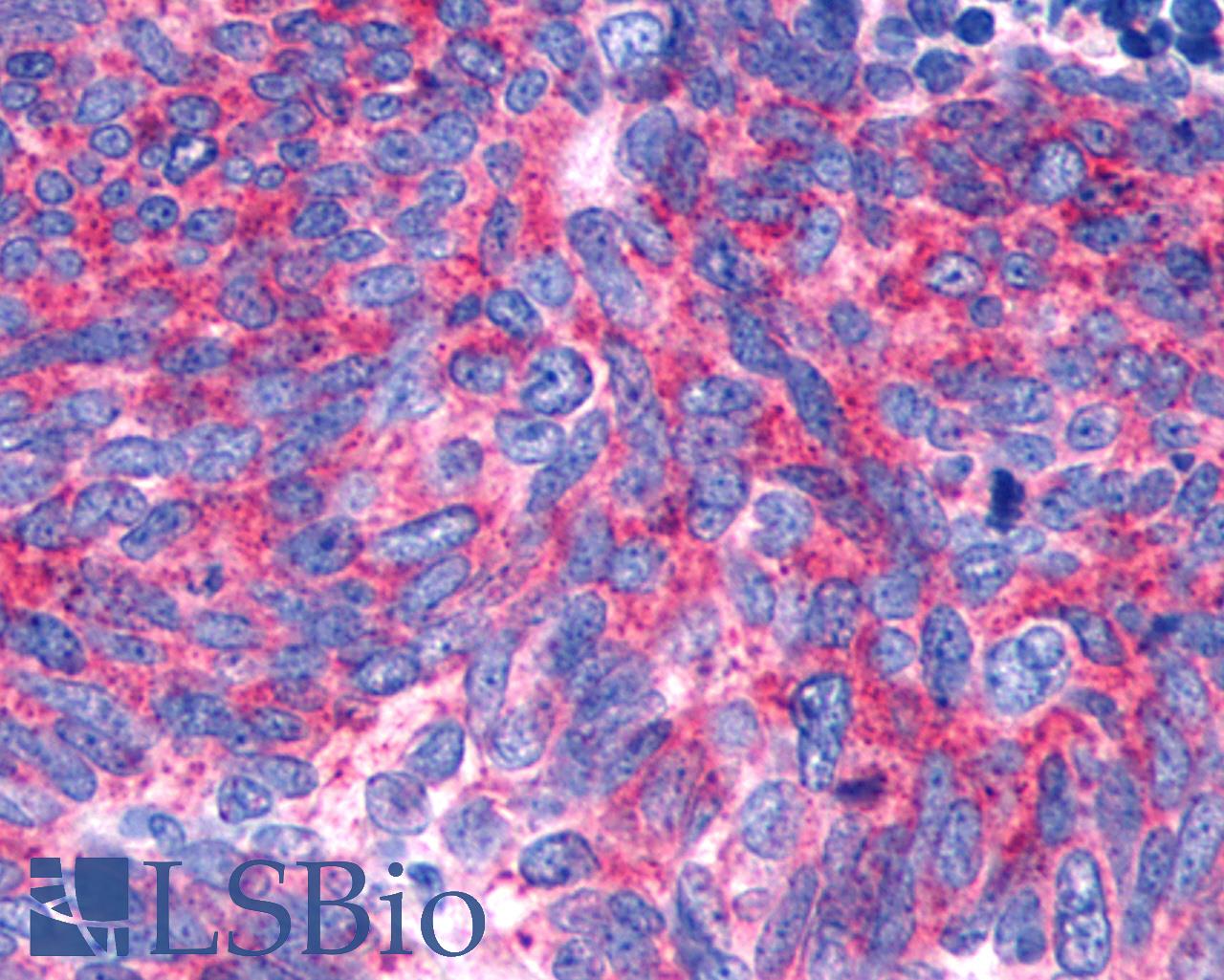 GPR146 Antibody - Anti-GPR146 antibody IHC of human Lung, Small Cell Carcinoma. Immunohistochemistry of formalin-fixed, paraffin-embedded tissue after heat-induced antigen retrieval.