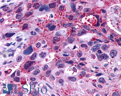 GPR146 Antibody - Pancreas, Carcinoma