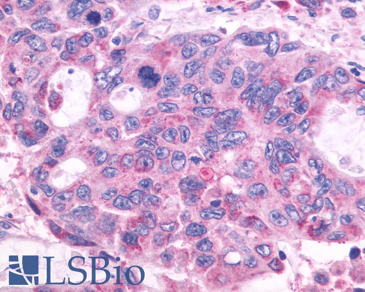 GPR150 Antibody - Colon, Carcinoma