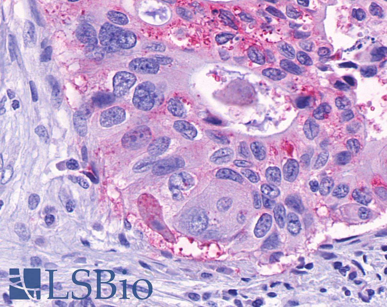 GPR150 Antibody - Pancreas, carcinoma
