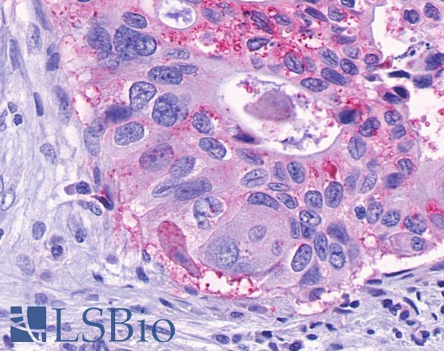 GPR150 Antibody - Pancreas, carcinoma