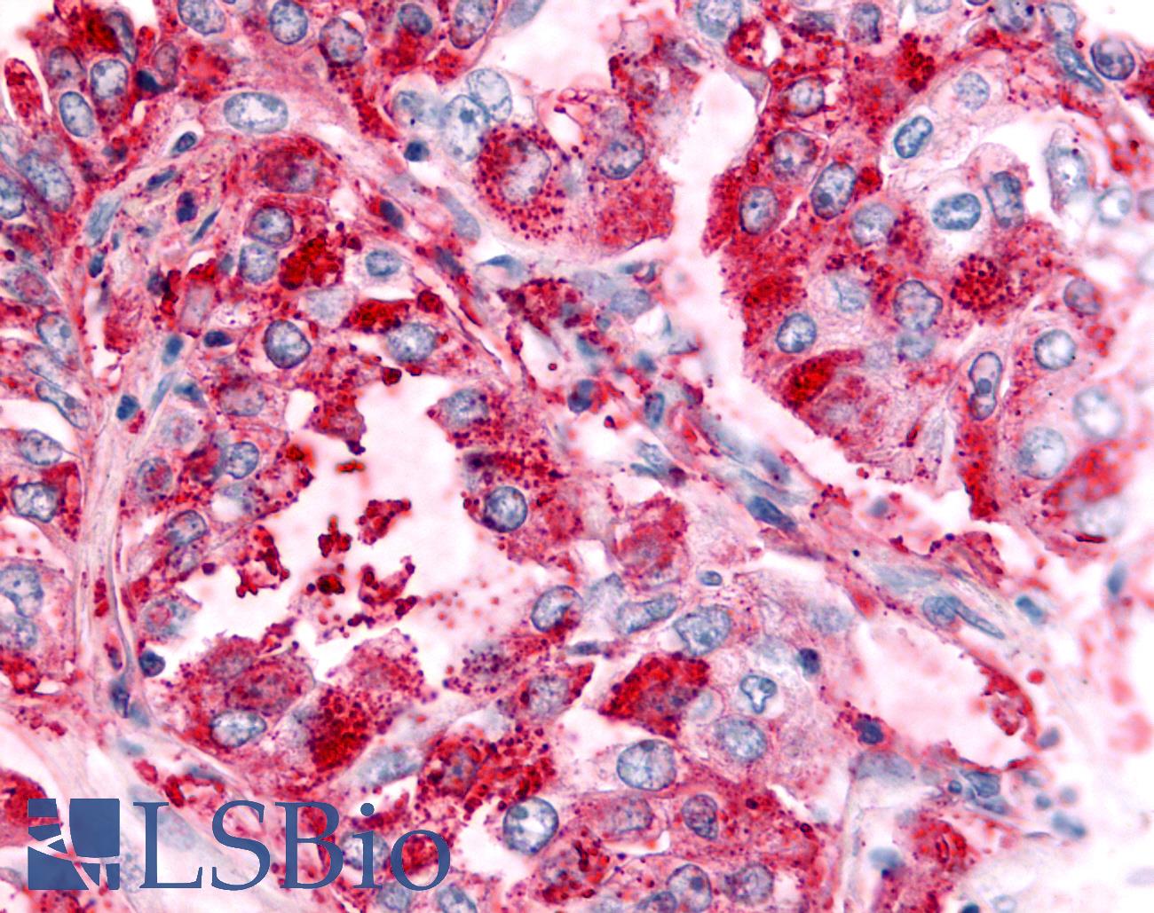 GPR151 Antibody - Anti-GPR151 antibody IHC of human Lung, Non-Small Cell Carcinoma. Immunohistochemistry of formalin-fixed, paraffin-embedded tissue after heat-induced antigen retrieval.