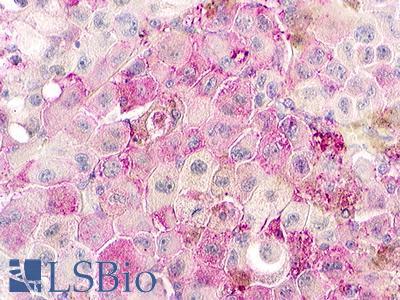 GPR152 Antibody - Skin, Malignant Melanoma