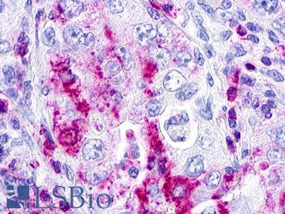 GPR152 Antibody - Lung, non small-cell carcinoma