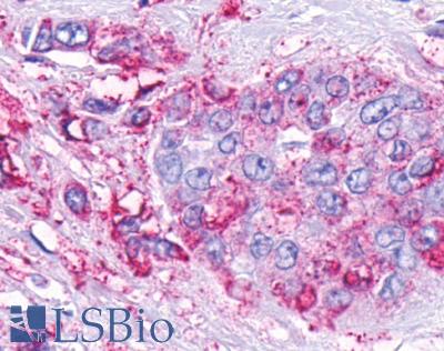 GPR161 Antibody - Pancreas, adenocarcinoma