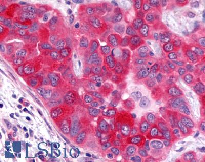 GPR17 Antibody - Lung, non small cell carcinoma