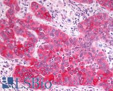 GPR17 Antibody - Anti-GPR17 antibody IHC of human Lung, Non-Small Cell Carcinoma. Immunohistochemistry of formalin-fixed, paraffin-embedded tissue after heat-induced antigen retrieval.