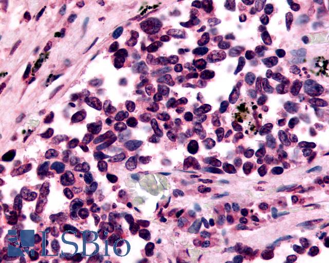 GPR182 / ADMR Antibody - Anti-GPR182 / ADMR antibody IHC of human Lung, Small Cell Carcinoma. Immunohistochemistry of formalin-fixed, paraffin-embedded tissue after heat-induced antigen retrieval.