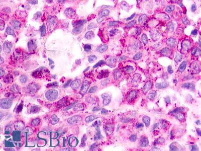 GPR183 / EBI2 Antibody - Breast, adenocarcinoma
