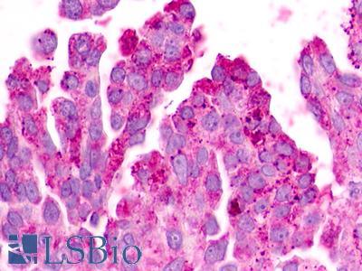 GPR183 / EBI2 Antibody - Ovary, Carcinoma