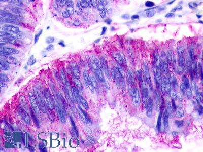 GPR183 / EBI2 Antibody - Colon, adenocarcinoma