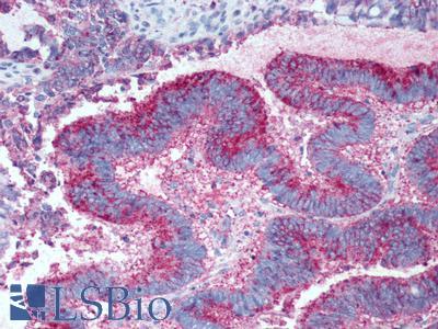 GPR19 Antibody - Colon, adenocarcinoma
