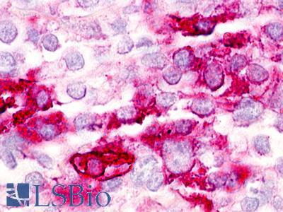GPR21 Antibody - Ovary, carcinoma