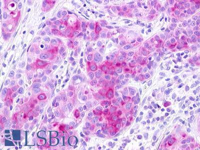 GPR25 Antibody - Breast, Carcinoma