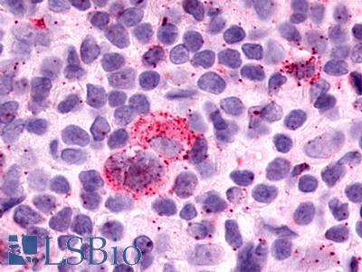 GPR25 Antibody - Hodgkin's lymphoma