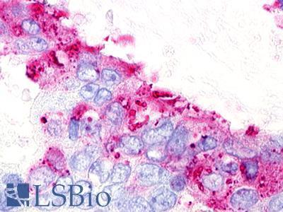 GPR25 Antibody - Colon, Carcinoma