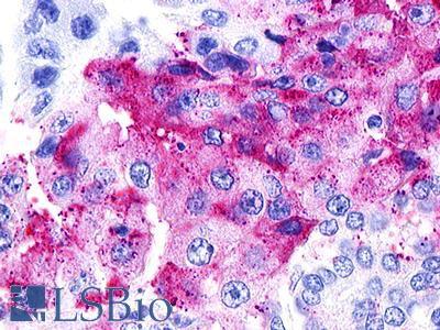GPR25 Antibody - Lung, adenocarcinoma