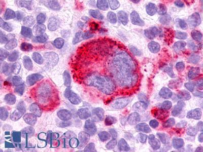 GPR25 Antibody - Hodgkin's lymphoma