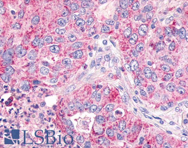 GPR26 Antibody - Lung, Non Small-Cell Carcinoma