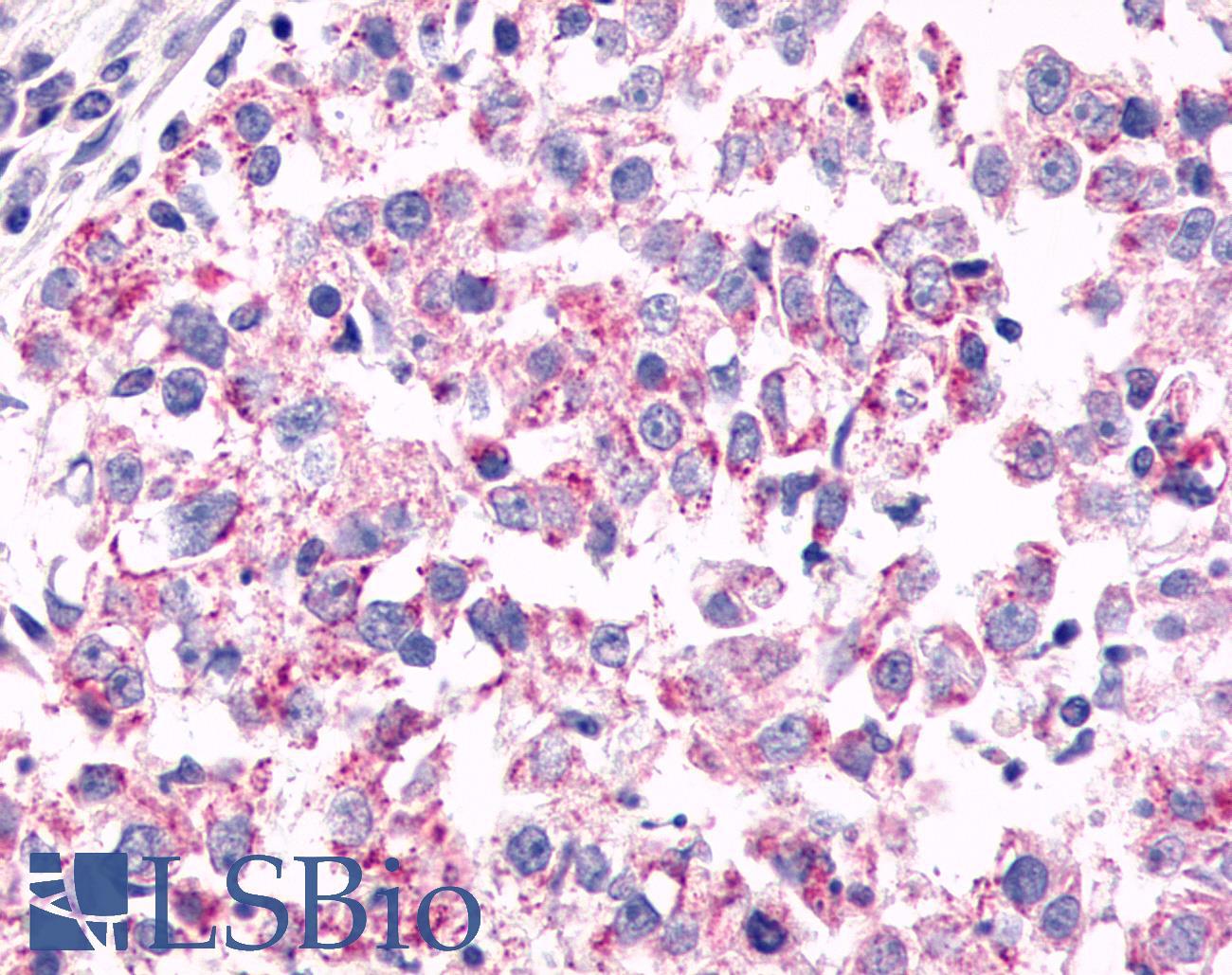 GPR26 Antibody - Breast, Carcinoma