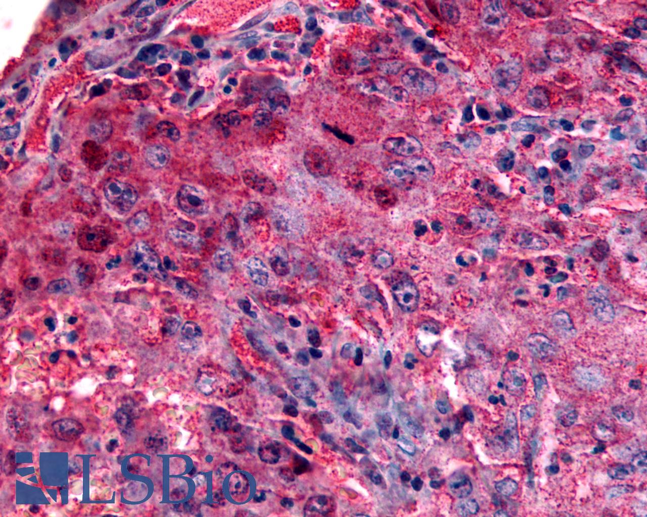 GPR27 Antibody - Anti-GPR27 antibody IHC of human Lung, Non-Small Cell Carcinoma. Immunohistochemistry of formalin-fixed, paraffin-embedded tissue after heat-induced antigen retrieval.