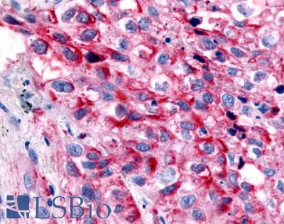 GPR32 Antibody - Lung, non small cell carcinoma