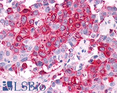 GPR34 Antibody - Breast, adenocarcinoma