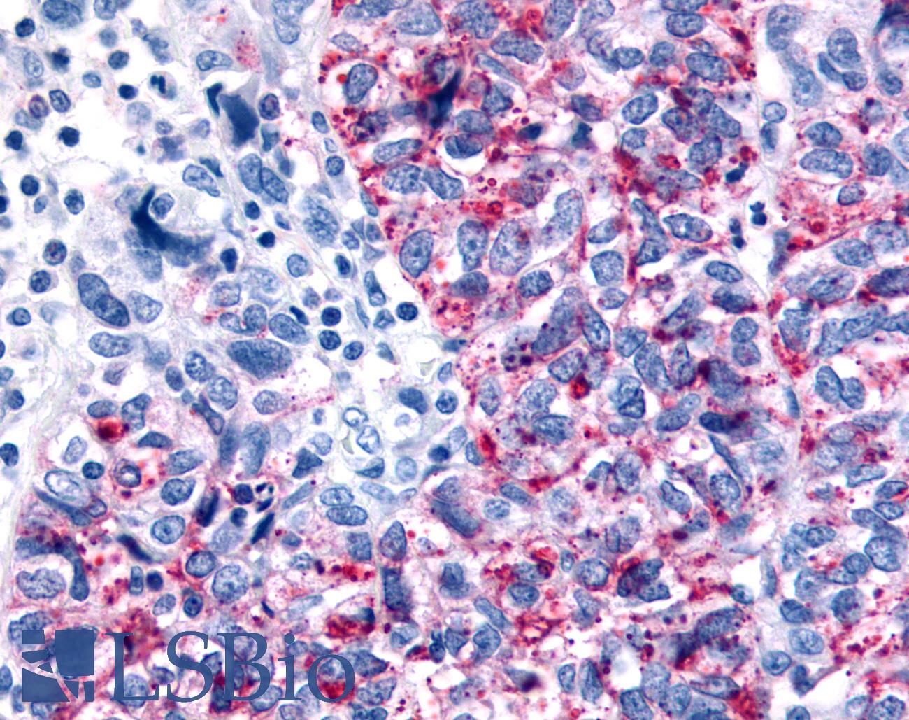 GPR35 Antibody - Anti-GPR35 antibody IHC of human Ovary, Carcinoma. Immunohistochemistry of formalin-fixed, paraffin-embedded tissue after heat-induced antigen retrieval.