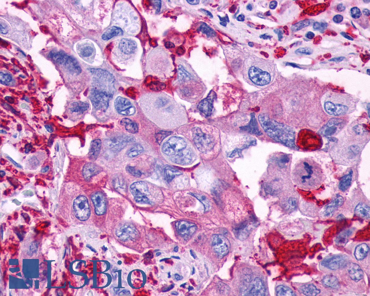 GPR39 Antibody - Anti-GPR39 antibody IHC of human Pancreas, Carcinoma. Immunohistochemistry of formalin-fixed, paraffin-embedded tissue after heat-induced antigen retrieval.