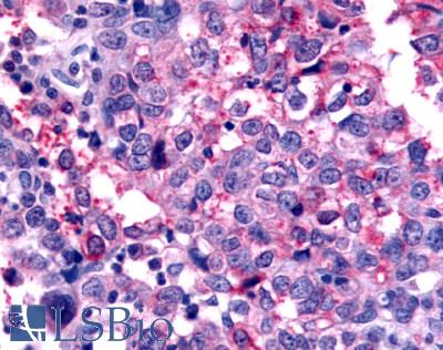 GPR45 Antibody - Ovary, Carcinoma