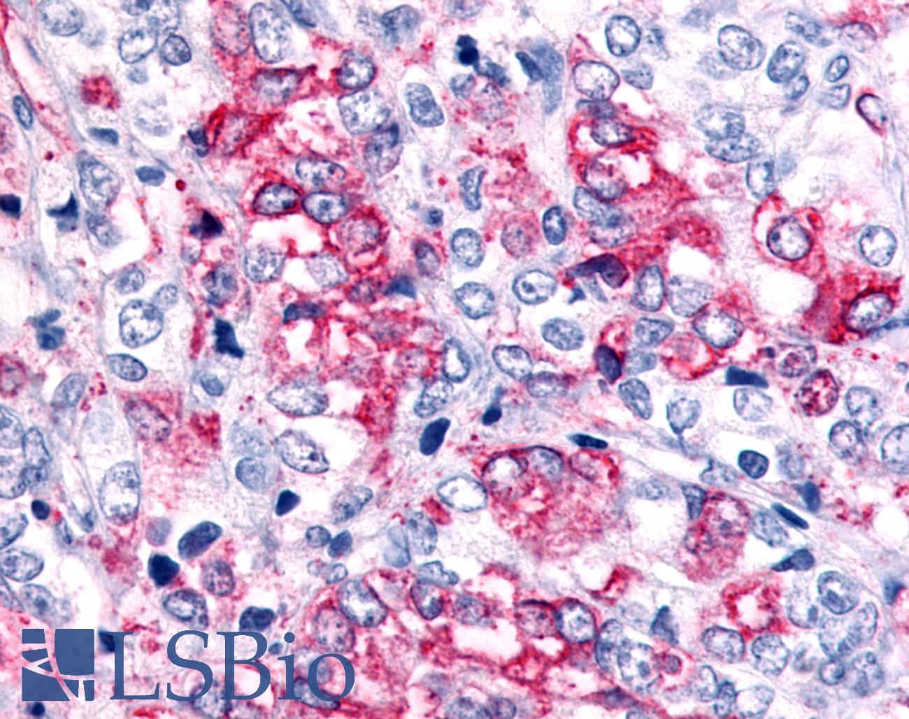 GPR45 Antibody - Anti-GPR45 antibody IHC of human Prostate, Carcinoma. Immunohistochemistry of formalin-fixed, paraffin-embedded tissue after heat-induced antigen retrieval.