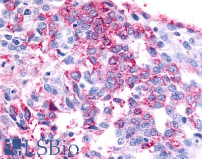 GPR45 Antibody - Ovary, Carcinoma