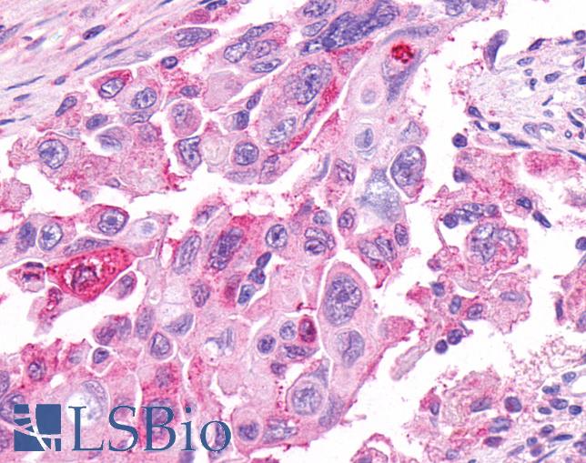 GPR48 / LGR4 Antibody - Anti-GPR48 / LGR4 antibody IHC of human Pancreas, Carcinoma. Immunohistochemistry of formalin-fixed, paraffin-embedded tissue after heat-induced antigen retrieval.