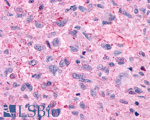 GPR48 / LGR4 Antibody - Anti-GPR48 / LGR4 antibody IHC of human Brain, Glioblastoma. Immunohistochemistry of formalin-fixed, paraffin-embedded tissue after heat-induced antigen retrieval.